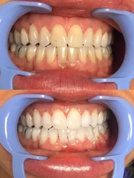 Teeth Whitening & Smile Care 2